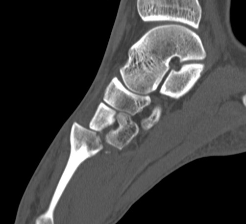 Lis Franc CT Dorsal Displacement MT